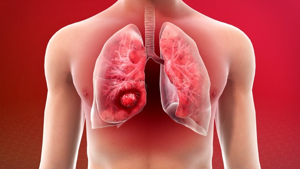 Why more women are diagnosed with lung cancer than men?