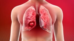 Why more women are diagnosed with lung cancer than men?
