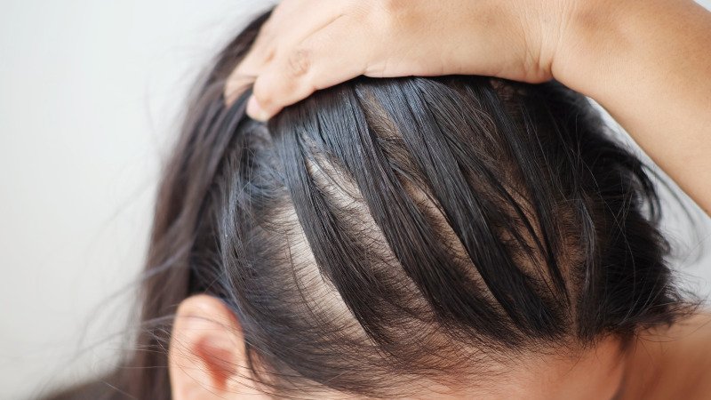 Hair loss can be devastating for women, but it can also indicate other health issues. An expert from the American Academy