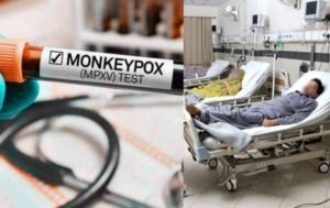 Lahore reports two suspected cases of monkeypox