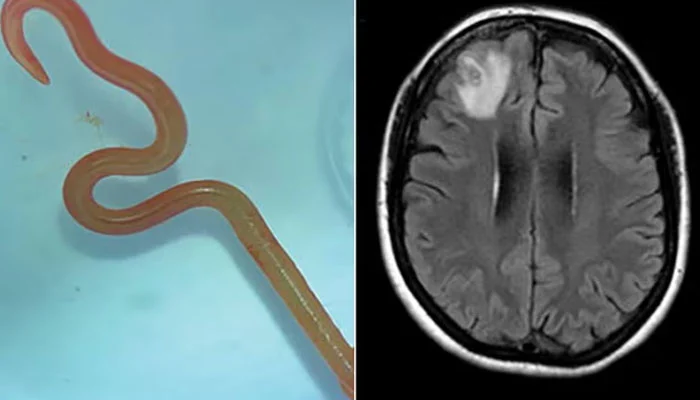 SHOCKING! 8cm python roundword pulled out from woman's brain