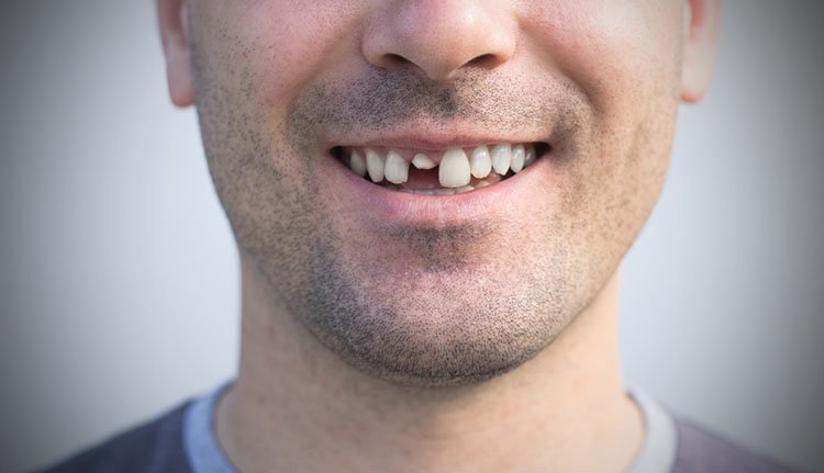 World's first tooth-regrowing drug to begin human trials in 2024