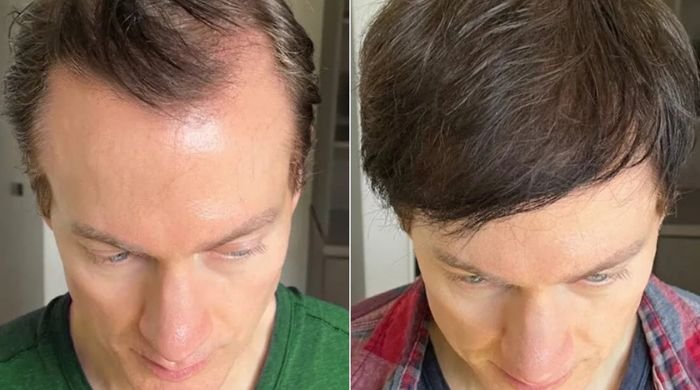 Tech Millionaire Bryan Johnson reveals how he reversed his hair loss, Shares details