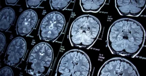 7 Brain Tumor Symptoms You Should not Ignore