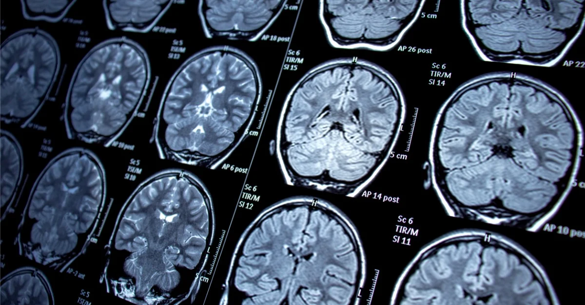 7 Brain Tumor Symptoms You Should not Ignore