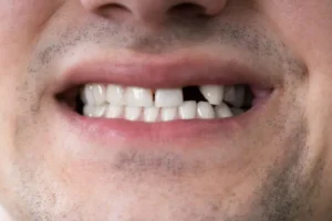 Japan Tests Tooth Regrowth Drug That Could Replace Dentures and Implants